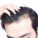 Hair transplantation in Karaj