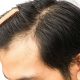 Cost of hair transplant in Karaj