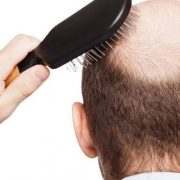 The best hair transplant doctor in Karaj