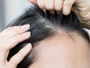 Cost of hair transplant in Karaj