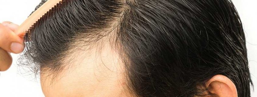 Cost of hair transplant in Karaj